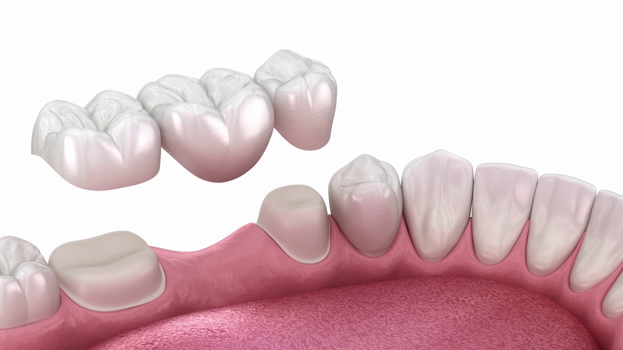 安置牙桥。三维动画视频下载