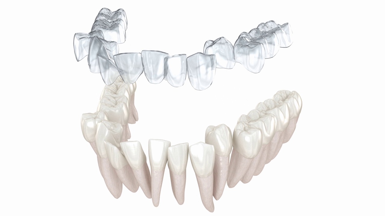 使用隐形牙套或隐形固位器进行咬合矫正。三维动画视频下载