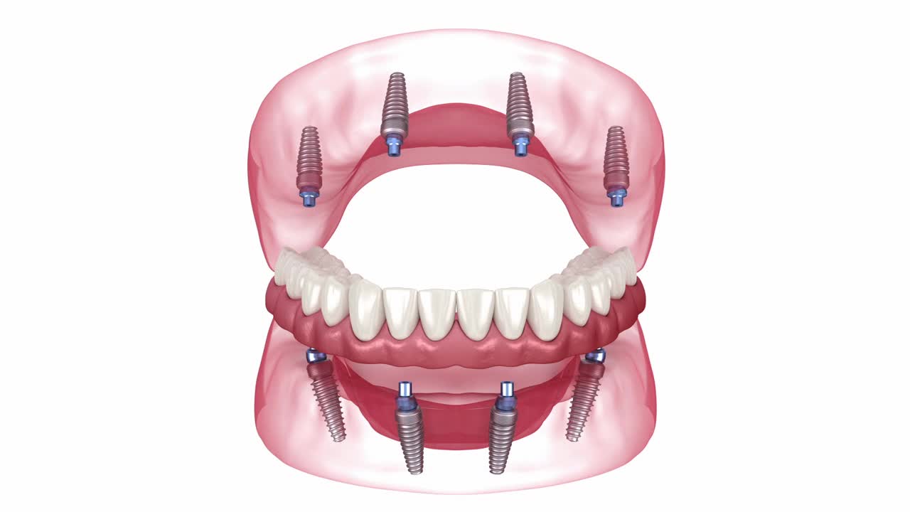 8个种植体支撑假体。牙科3D动画视频素材