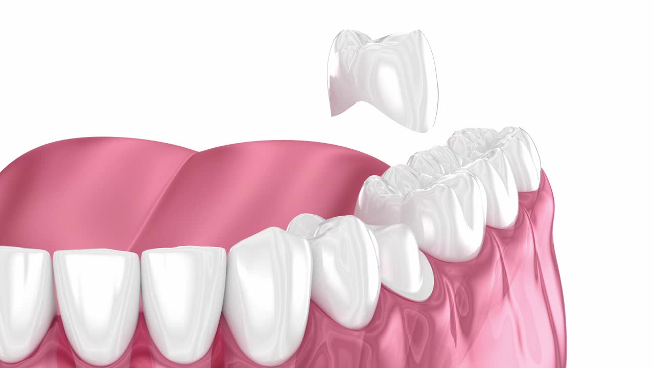 预备前磨牙和牙冠放置。牙科3D动画视频下载