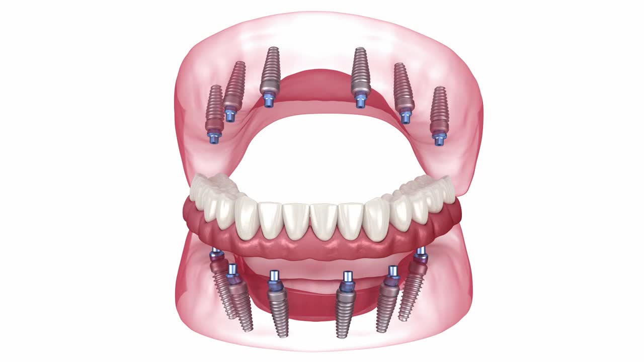 6个种植体支撑的假体。牙科3D动画视频下载