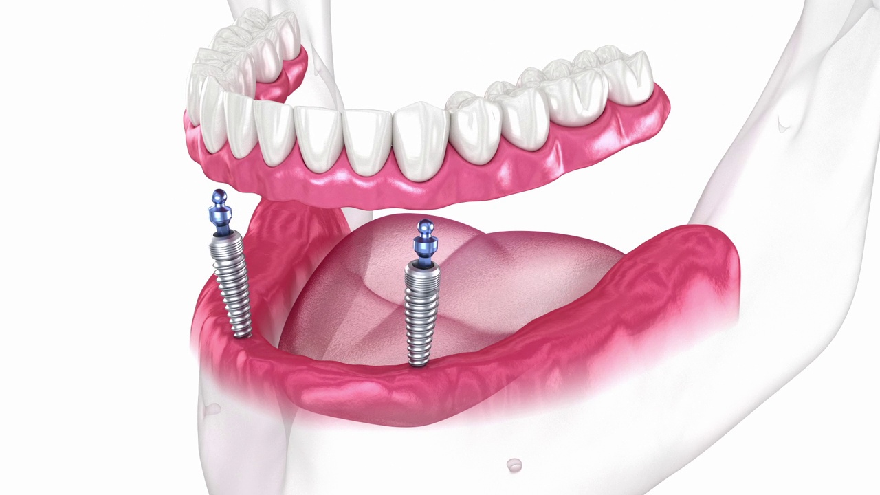 下颌可移动假体全对2系统支持种植体与球附件。牙科3D动画视频下载