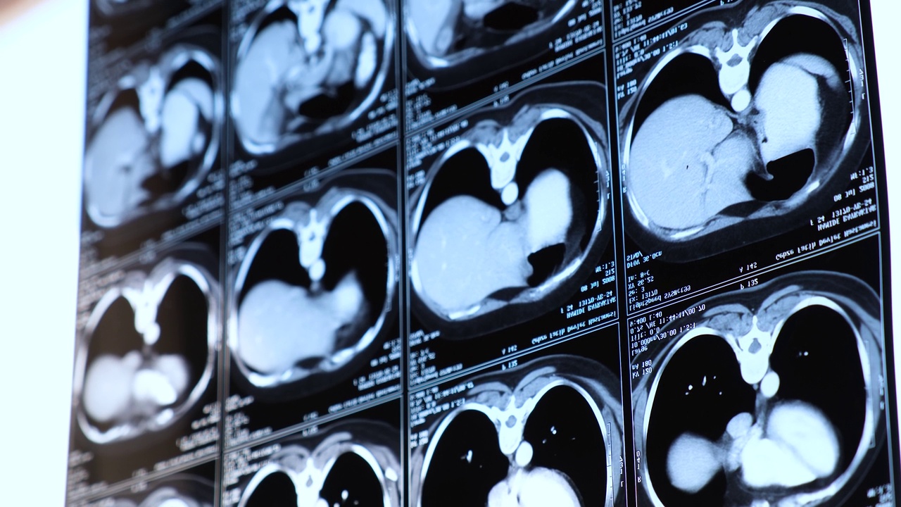 胸部腹部计算机断层扫描(CT)。医学、科学和教育CT背景视频素材