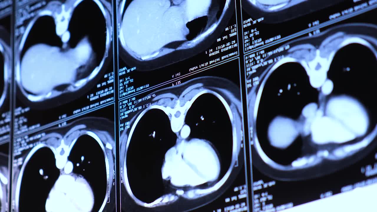 胸部腹部计算机断层扫描(CT)。医学、科学和教育CT背景视频素材