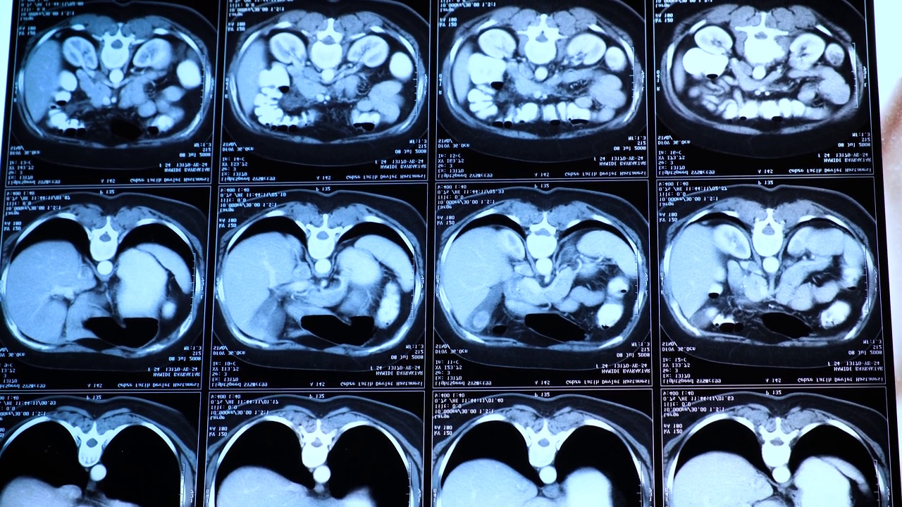 胸部腹部计算机断层扫描(CT)。医学、科学和教育CT背景视频素材