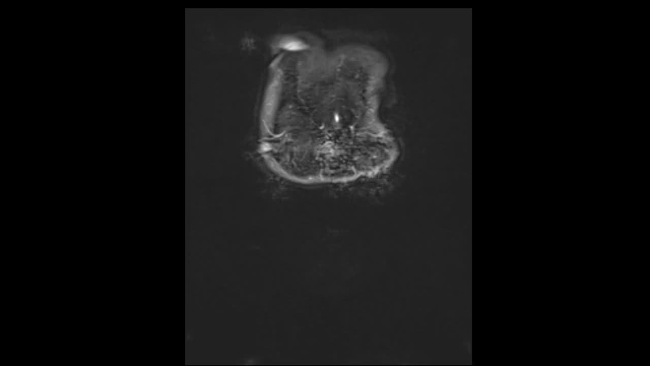 MRI全腹冠状位T2面视频素材