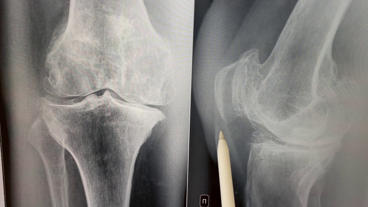 膝关节X线平片显示明显的kelgren - Lawrence系统骨性关节炎，软骨下硬化，膝关节炎症视频素材