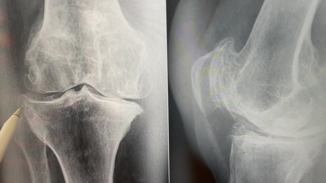 膝关节X线平片显示明显的kelgren - Lawrence系统骨性关节炎，软骨下硬化，膝关节炎症视频素材