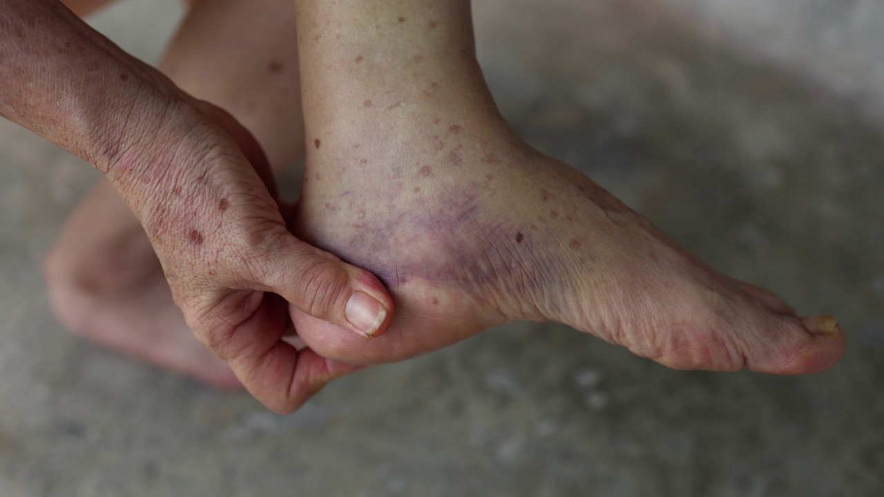 一位资深女性按摩脚部消肿的特写视频素材