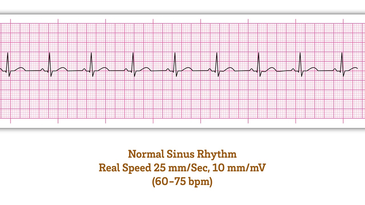 心电图正常窦性心律-动态心电图-实际速度25mm /秒和10mm /MV视频素材
