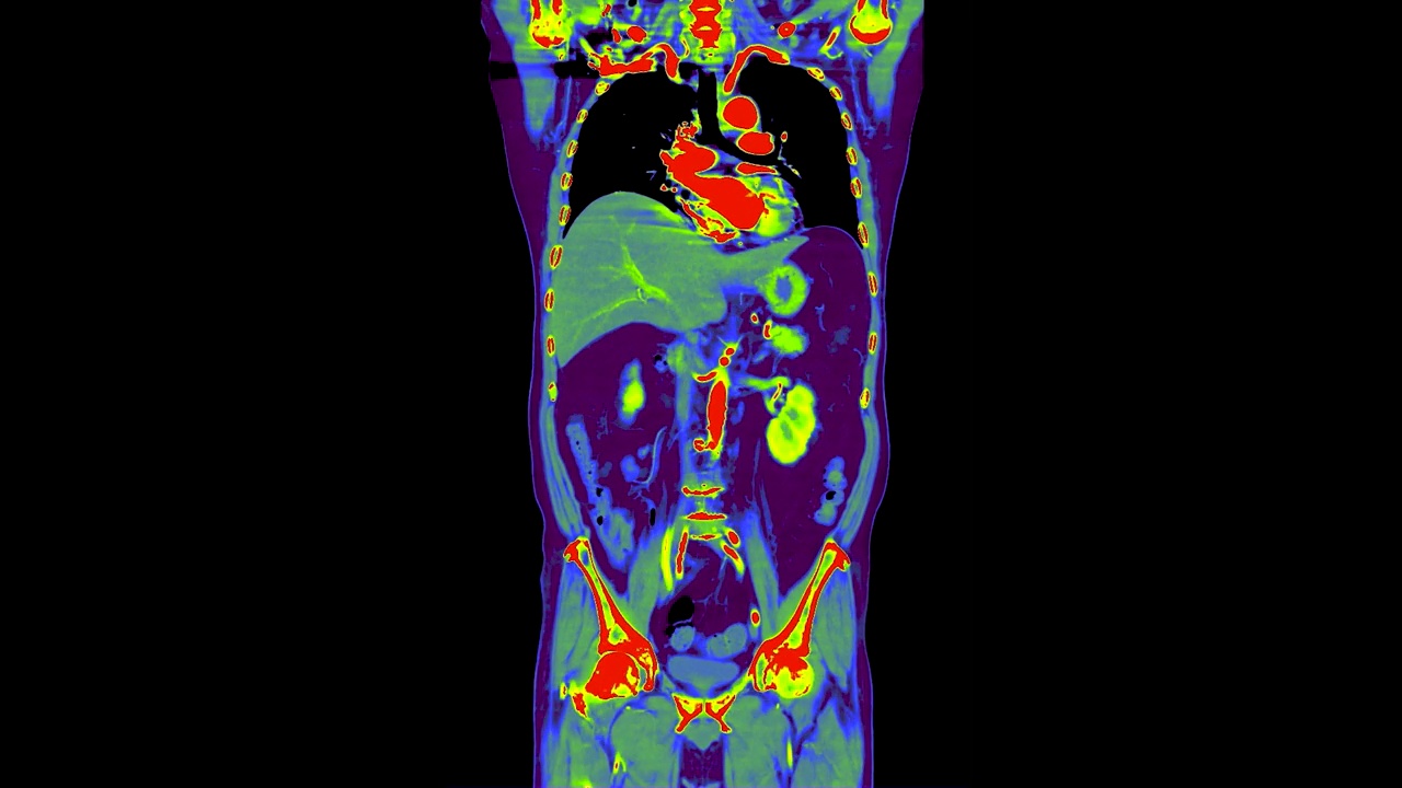 胸腹彩色CT扫描或Pet CT扫描。视频素材