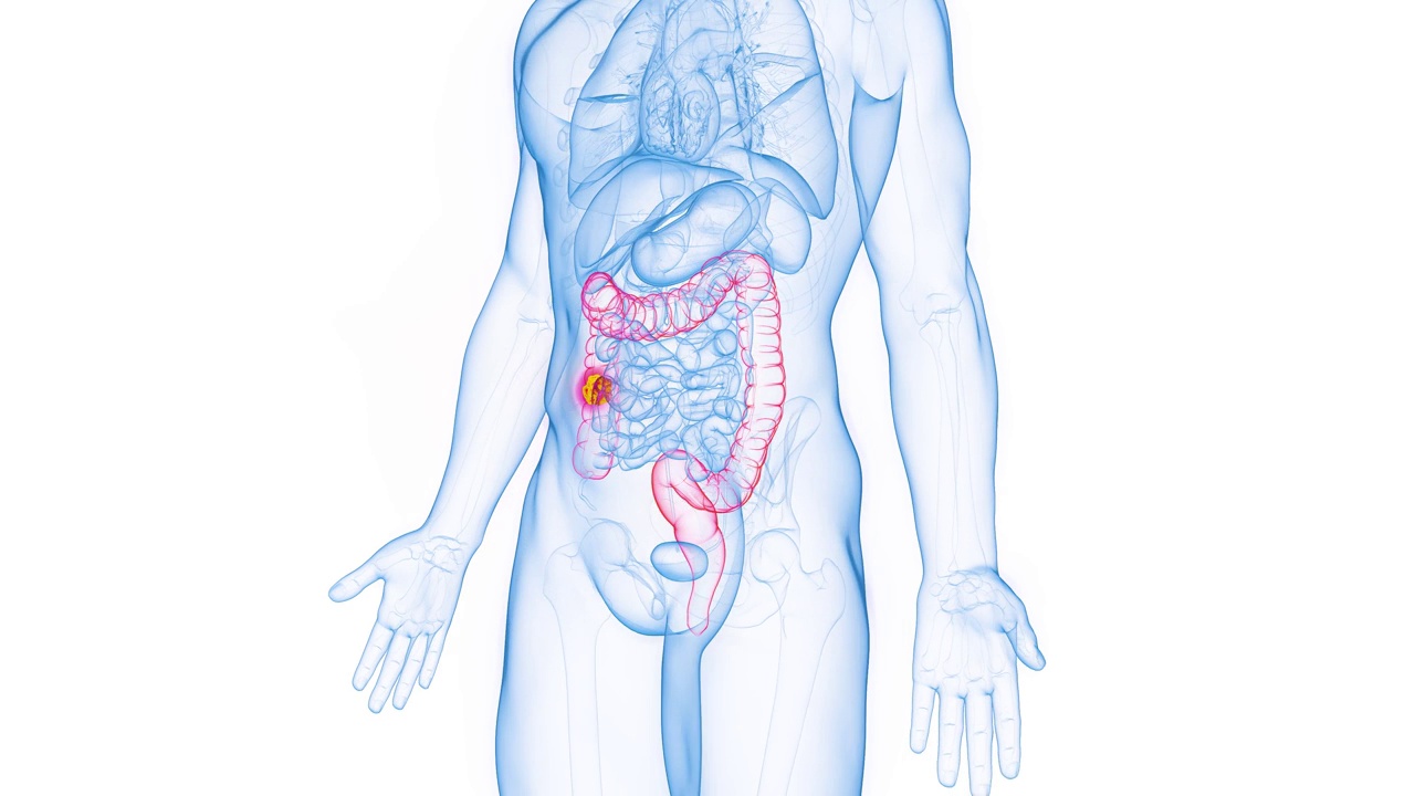 结肠癌在男性升结肠的动画视频素材