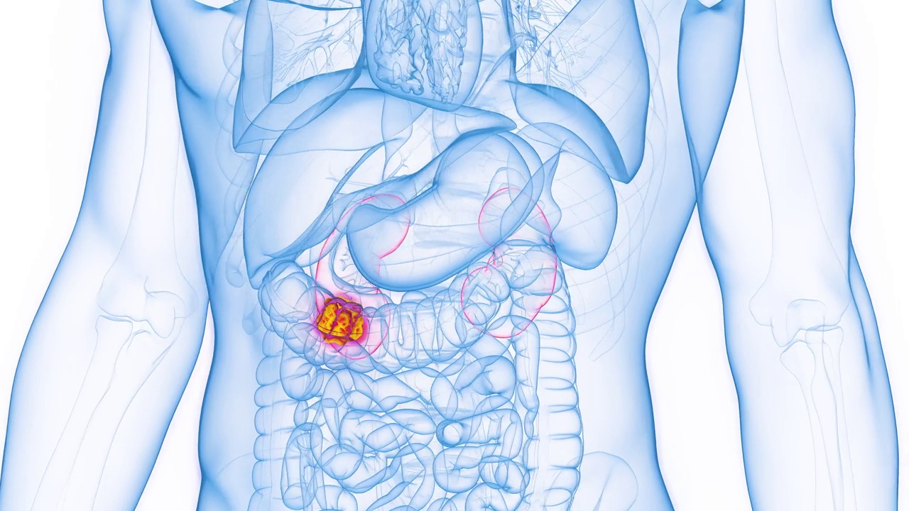 男性肾脏肿瘤肿块的动画视频素材