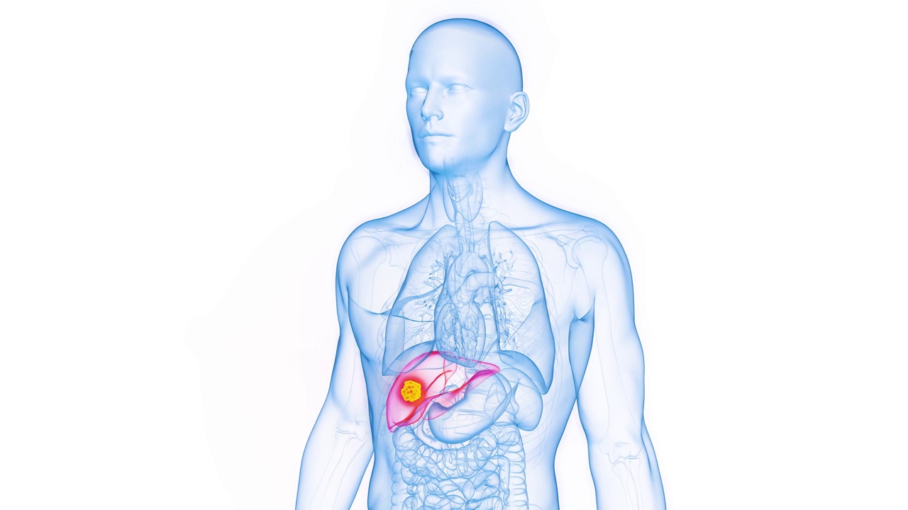 人类男性肝癌的动画视频素材