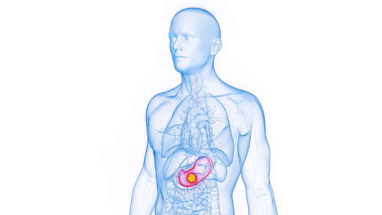 一个人胃部肿瘤生长的动画视频素材