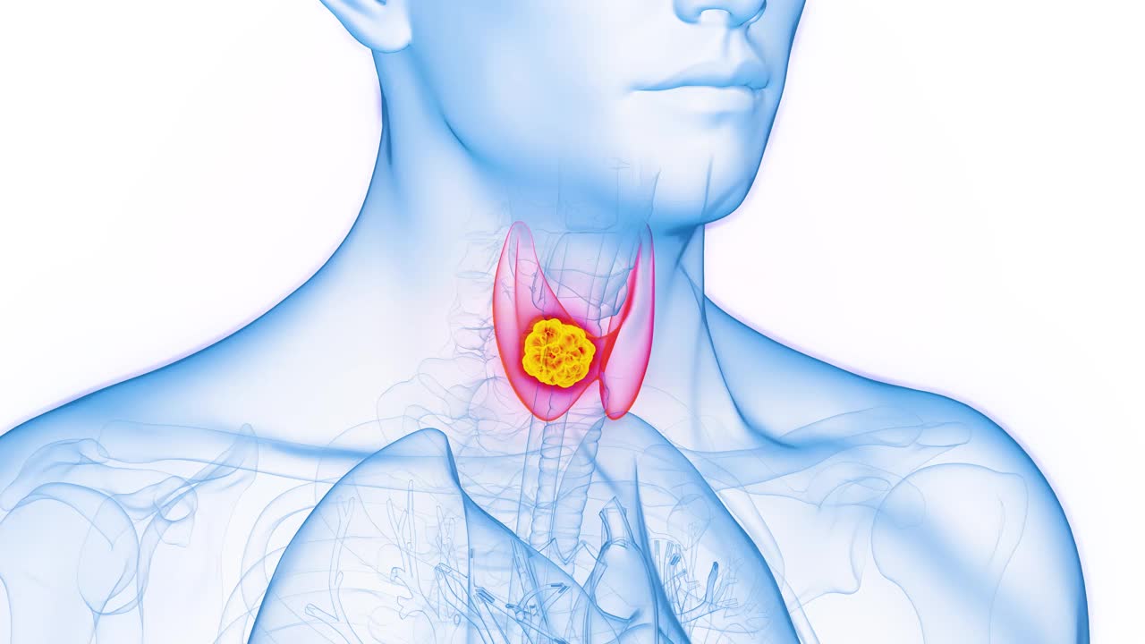 男子右甲状腺叶恶性肿瘤的动画视频素材