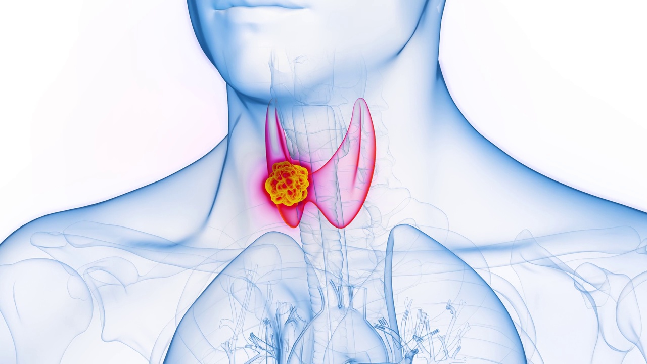 一个男人甲状腺癌肿瘤的动画视频素材