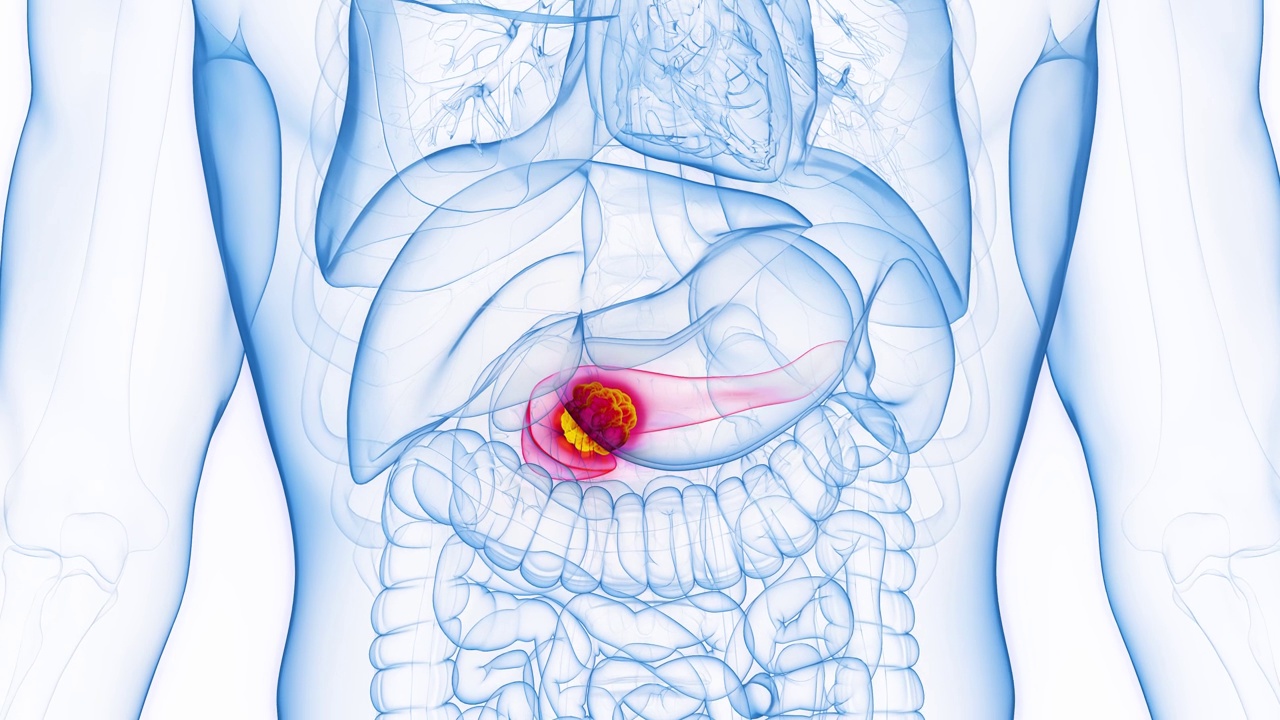 人类男性胰腺癌的动画视频素材