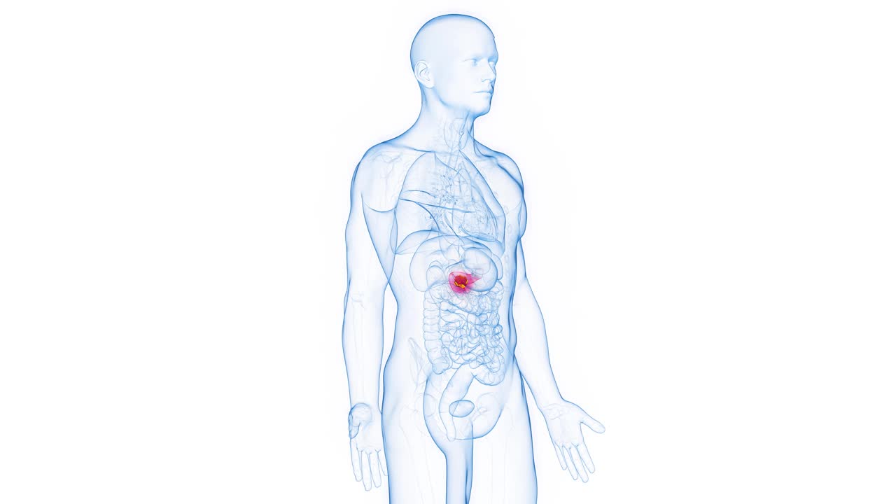 一个男人胰腺恶性肿块的动画视频素材