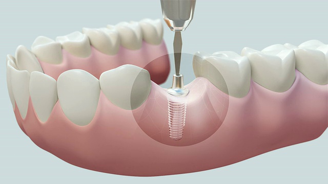 HD:牙齿种植体明亮视频素材