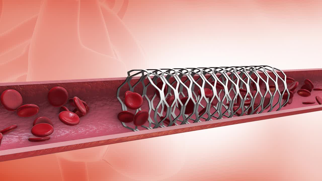 冠状动脉成形术支架置入的医学概念视频素材