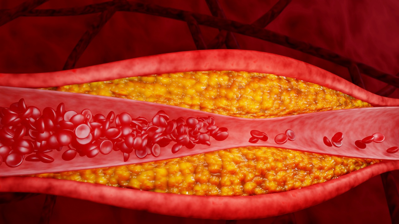 高脂血症。动脉阻塞的概念和人体血管作为一种疾病与胆固醇脂肪堆积堵塞。动脉阻塞，动脉中的胆固醇斑块。三维渲染视频素材