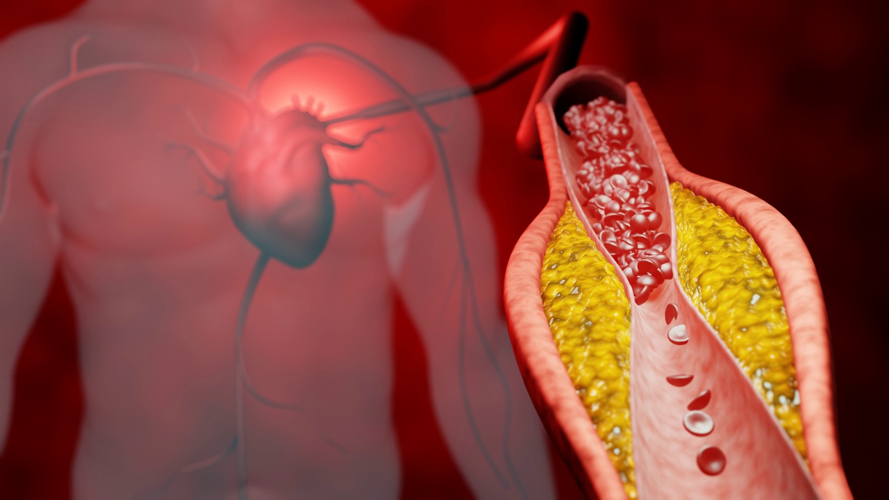 高脂血症。动脉阻塞的概念和人体血管作为一种疾病与胆固醇脂肪堆积堵塞。动脉阻塞，动脉中的胆固醇斑块。三维渲染视频素材