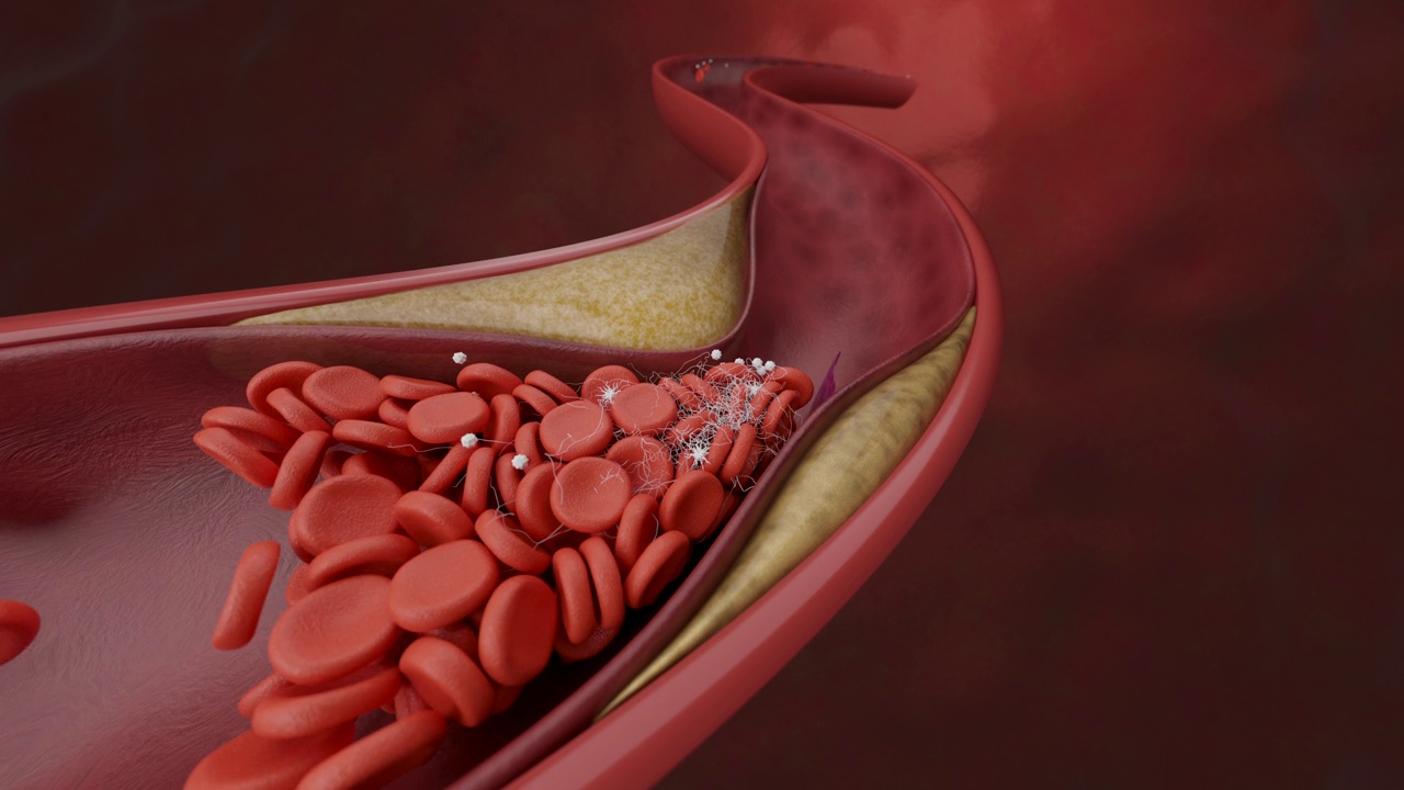 冠状动脉和血栓疾病视频素材