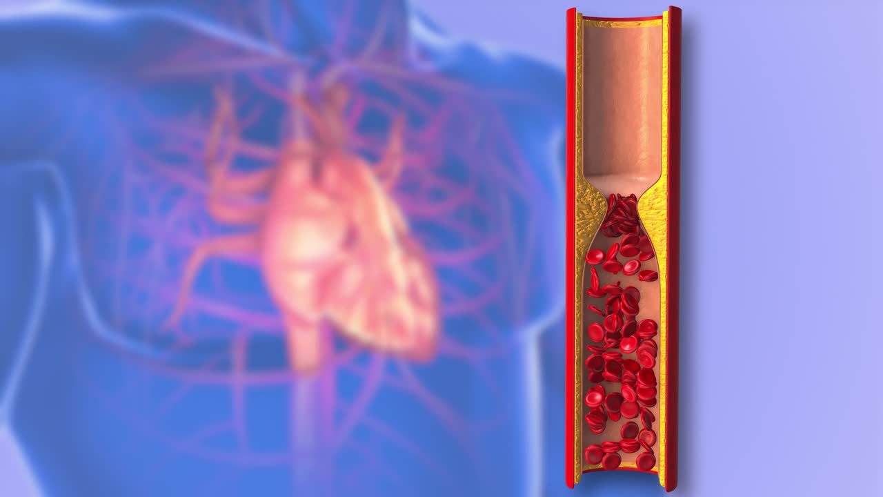 动脉粥样硬化或动脉阻塞的医学概念视频素材