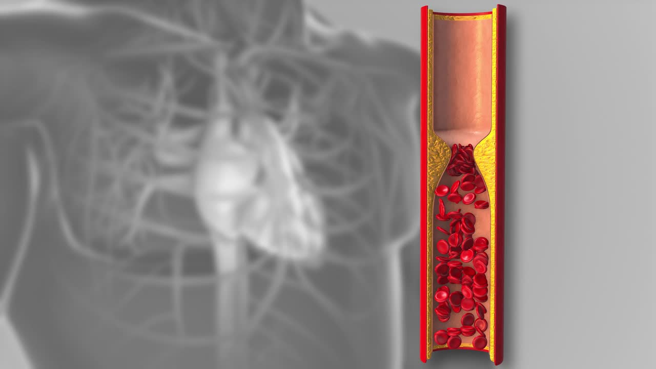 由动脉粥样硬化或动脉阻塞引起的心脏病视频素材