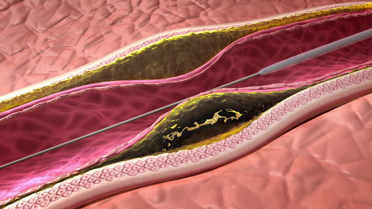 血管成形术解剖心脏病发作视频素材