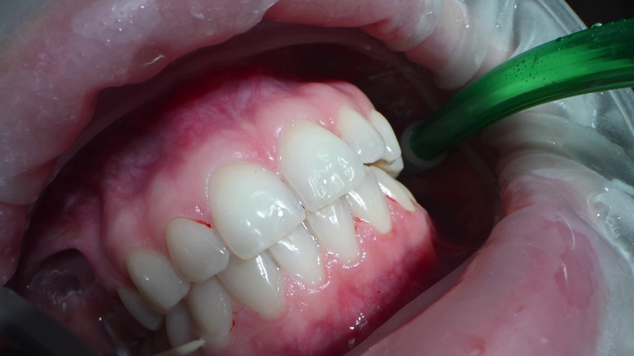 牙科极端近距离微距视频。病人口腔清洁过程。用喷水器和唾液喷射器清洁牙齿。专业口腔卫生理念。4k 120 FPS慢动作原始素材视频素材