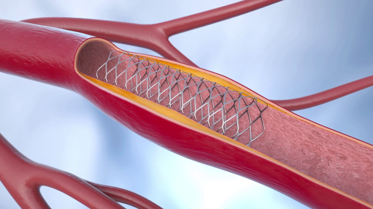 冠状动脉血管成形术视频素材