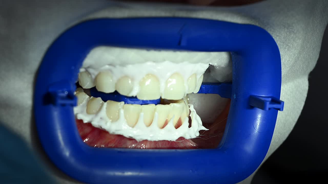 病人口腔的牙齿美白过程。使用UF灯、Led灯和凝胶美白牙齿。牙科极端近距离微距视频。专业口腔卫生理念。4k 120 FPS慢动作镜头视频素材