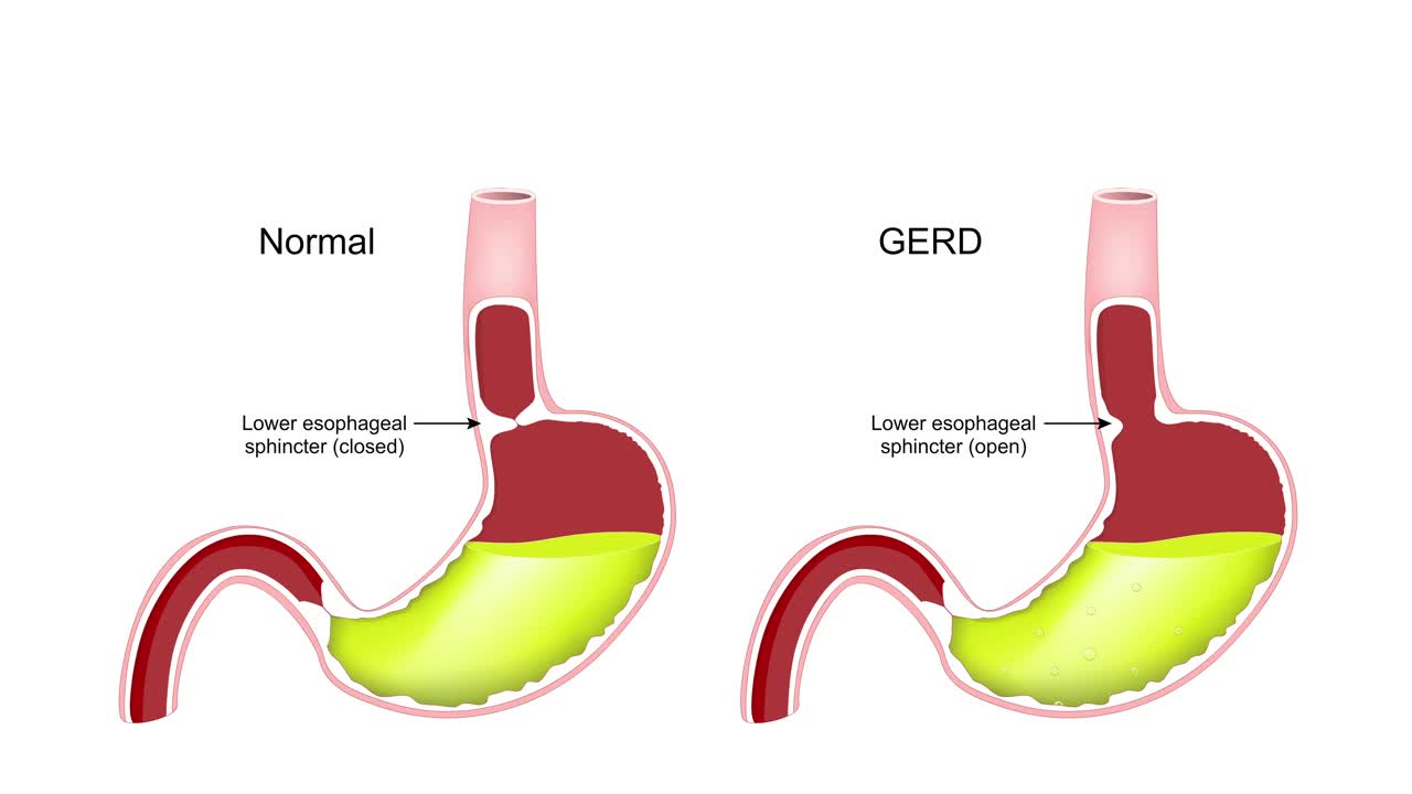 胃食管反流病。盖德。视频素材