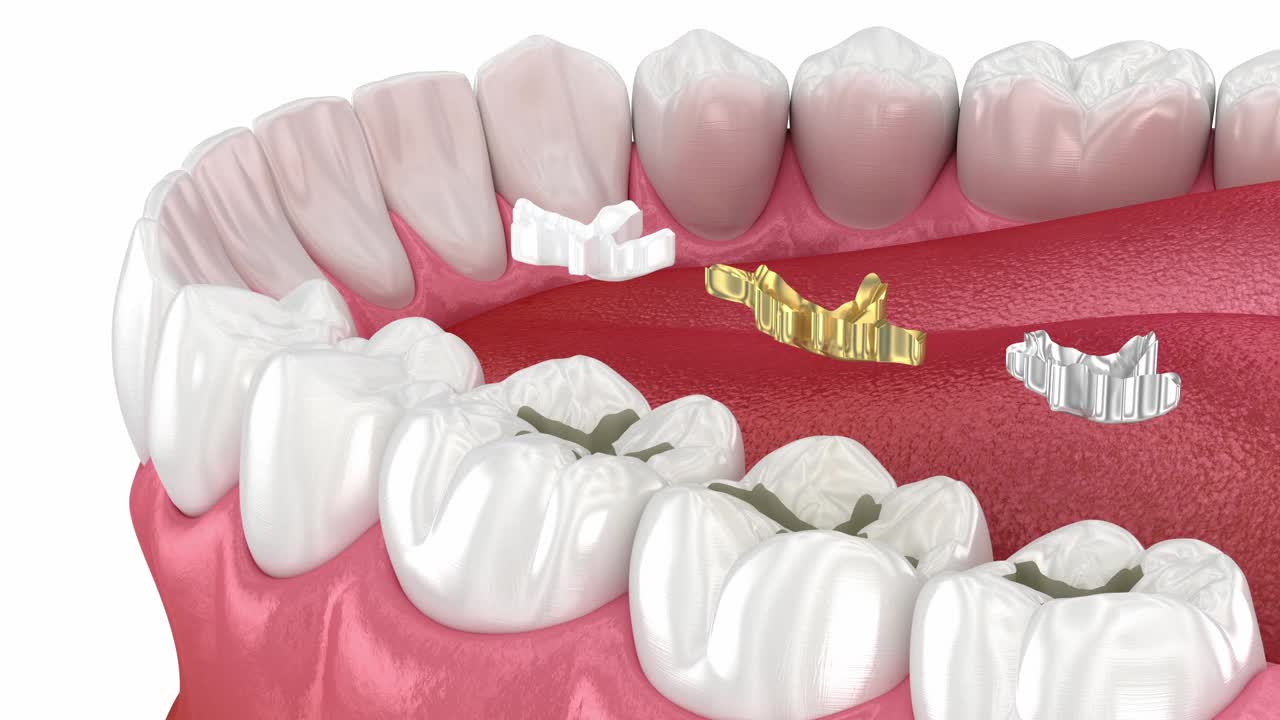 牙科填充物:陶瓷、黄金、金属。牙科3D动画视频下载