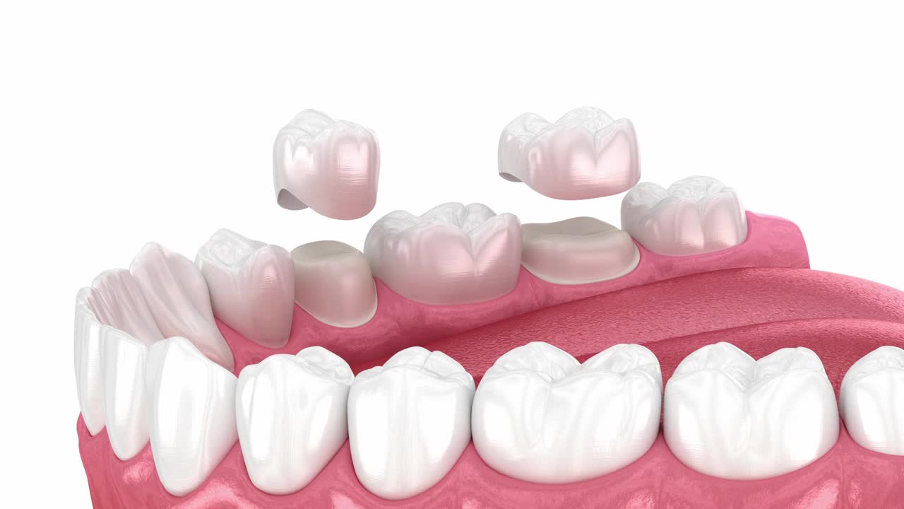 牙冠放置在牙齿上。牙科3D动画视频下载