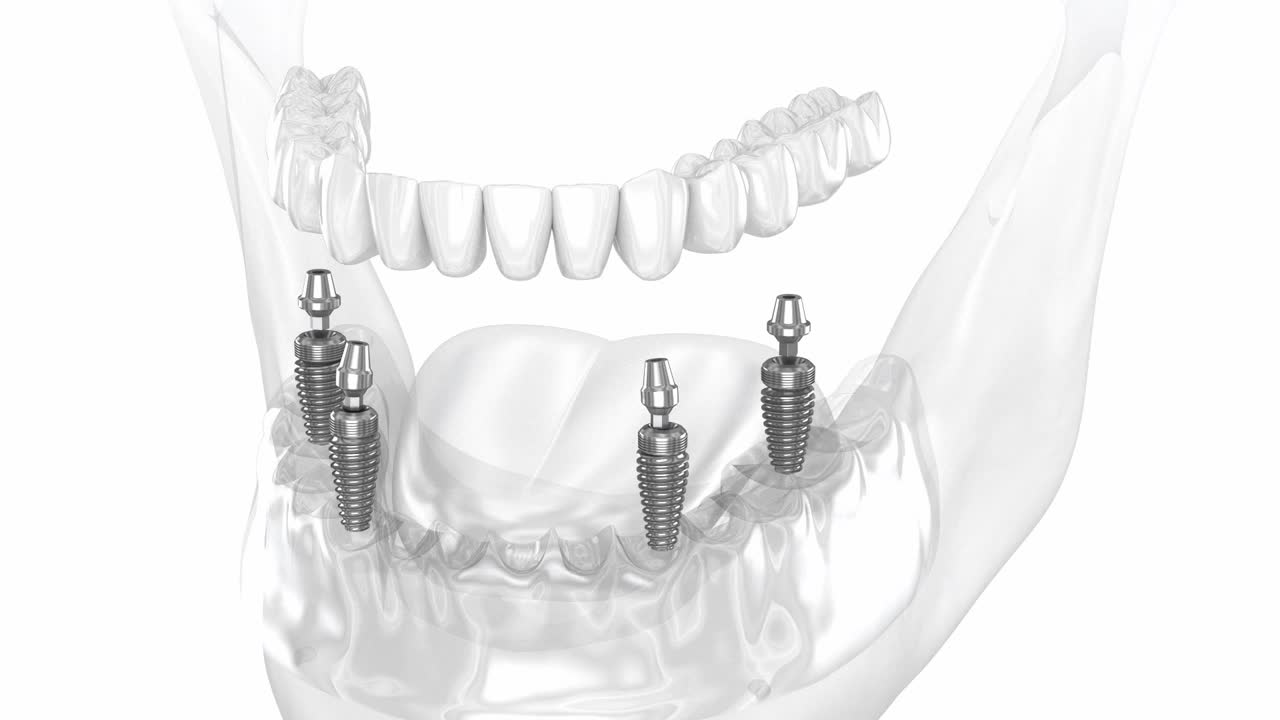 下颌假体均在4个种植体支撑系统上。牙科3D动画视频下载