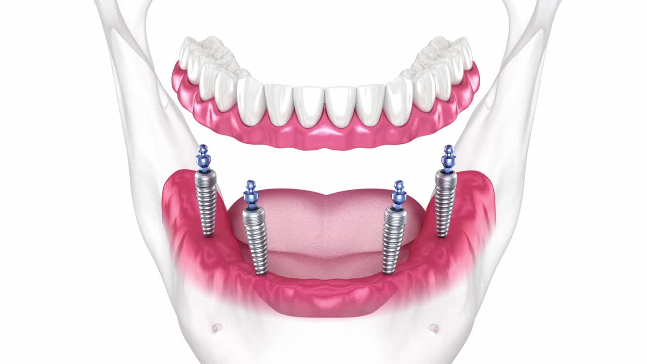 4个种植体支撑假体。牙科3D动画视频下载