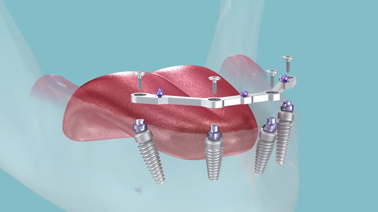 种植体支持的下颌假体。医学上精确的3D动画视频下载