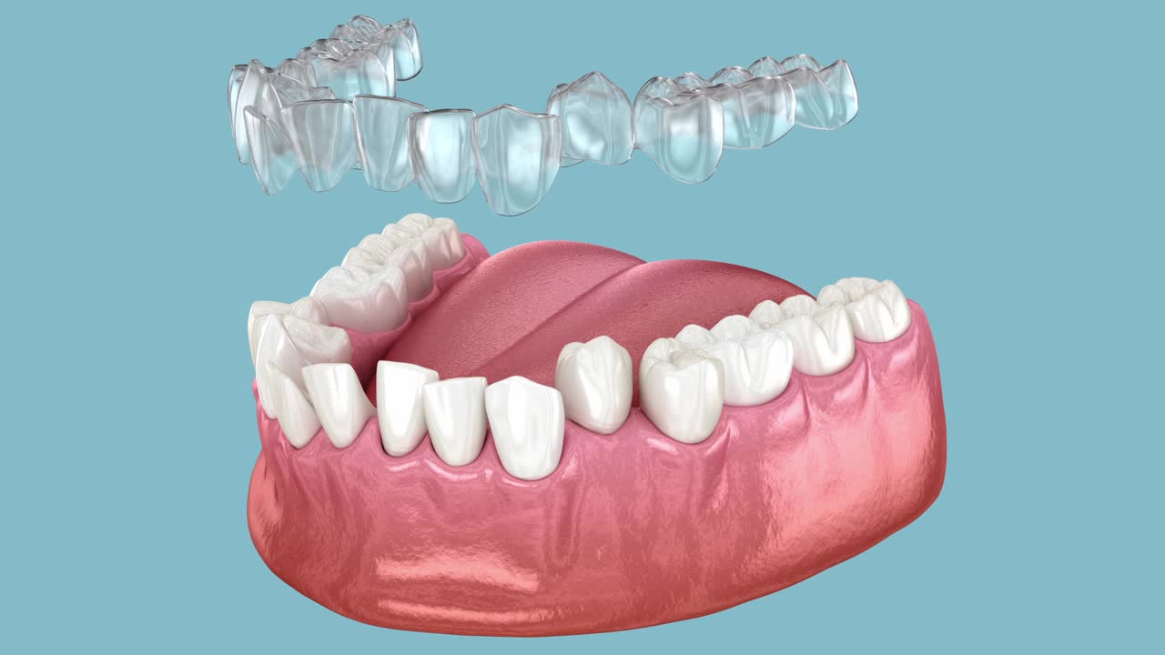使用隐形牙套或隐形固位器进行咬合矫正。医学上精确的3D动画视频下载
