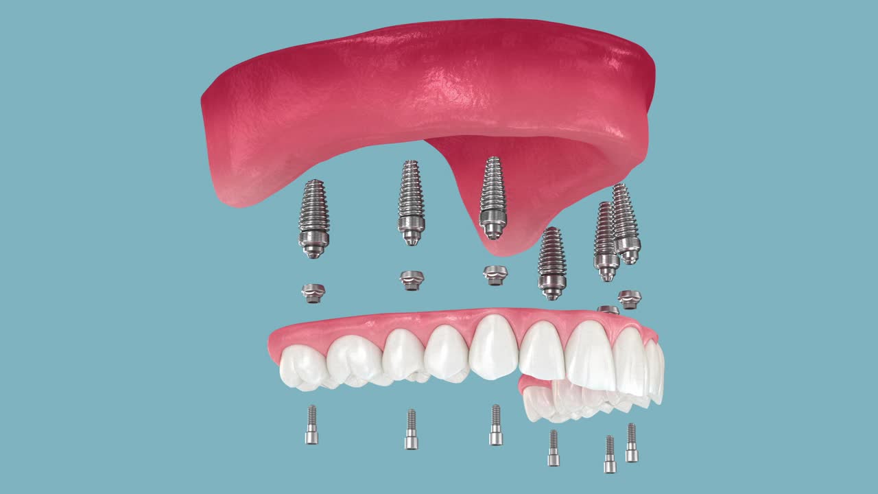 牙齿修复基于六个种植体，最后快乐的微笑。牙科3D动画视频下载