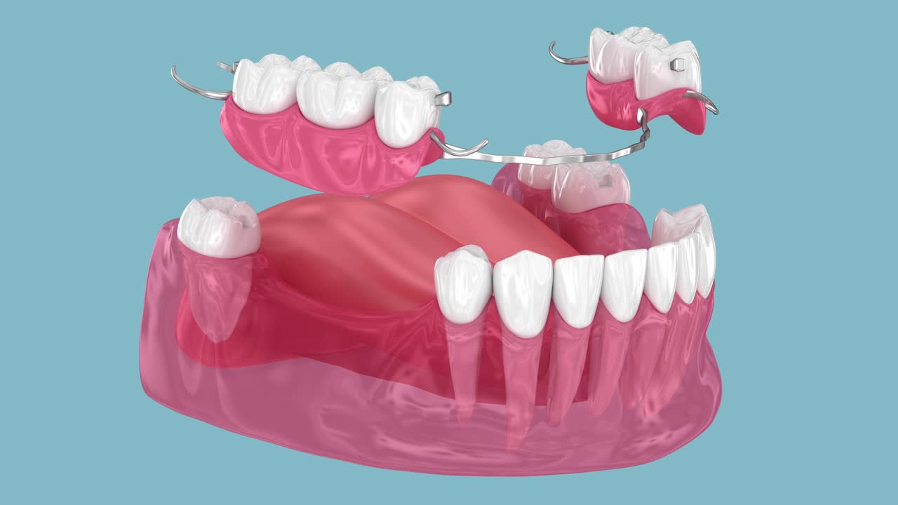 可移动部分义齿，下颌假体。医学上精确的3D动画修复学概念视频素材
