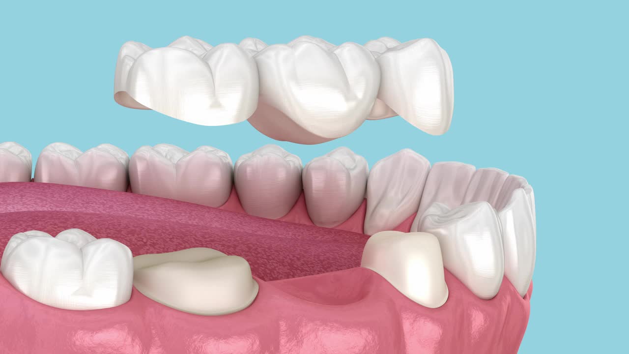 安置牙桥。三维动画视频下载