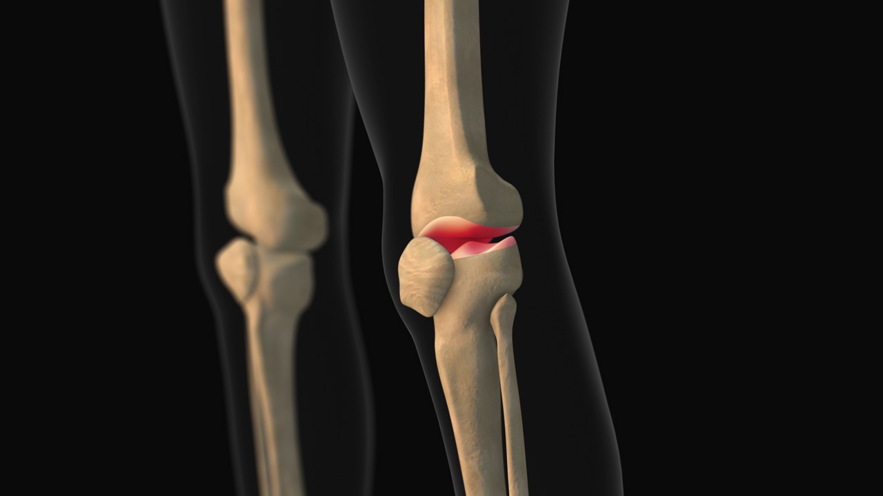 膝关节疼痛的医学动画视频素材