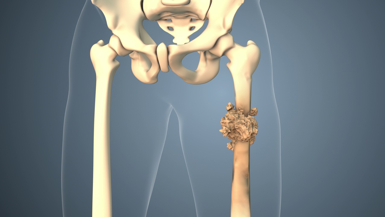 癌症沿大腿骨扩散视频素材