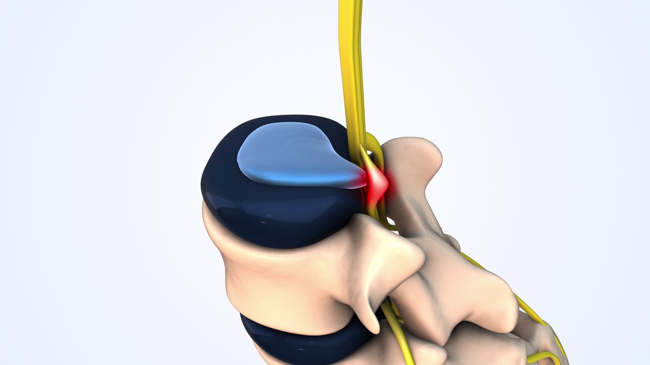 腰椎椎间盘突出症医学动画视频素材