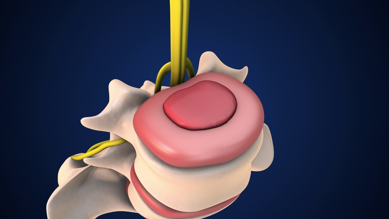 腰椎椎间盘突出症的医学动画分析视频素材