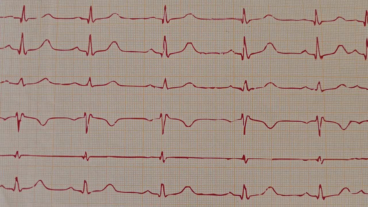 桌上有医学心电图和小红心视频素材