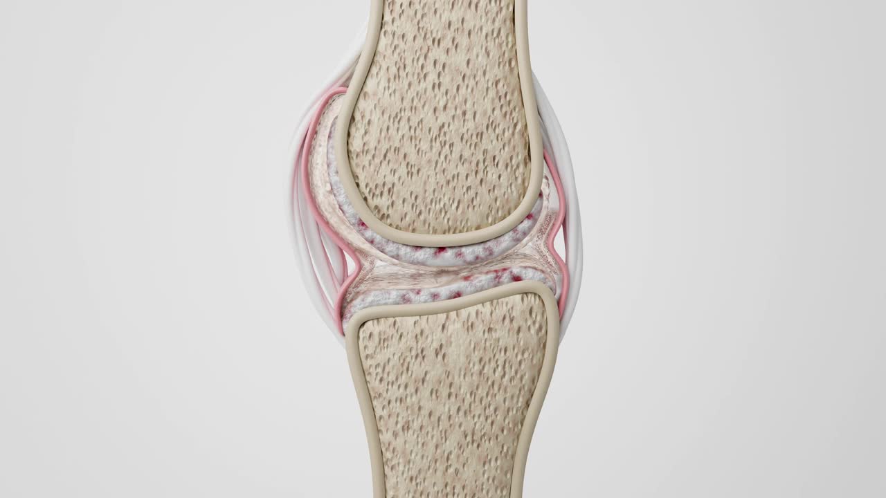 关节疼痛和骨关节炎视频下载